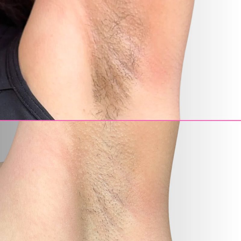 IPL Hair Removal — top-scored model